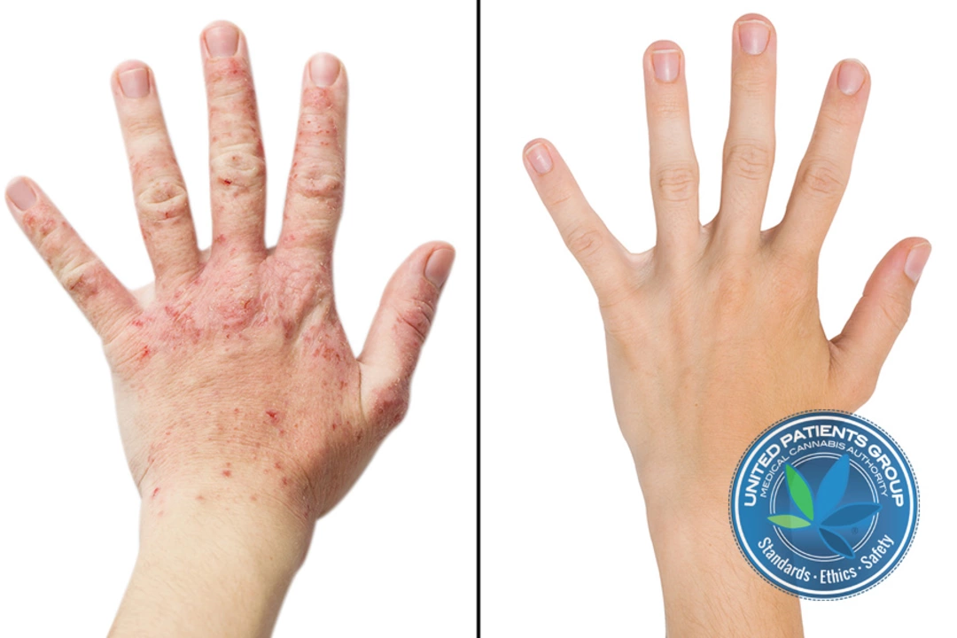 Acitretin and Inverse Psoriasis: Can It Help with This Difficult-to-Treat Form?