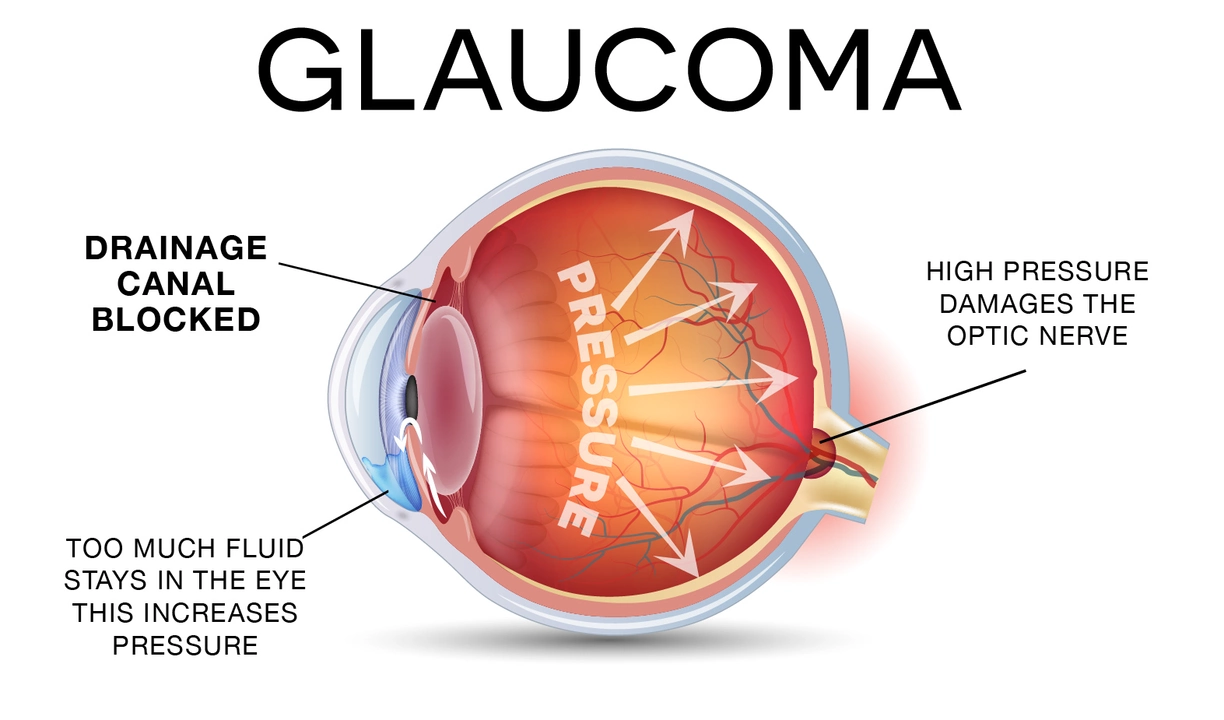 Understanding the Different Types of Glaucoma